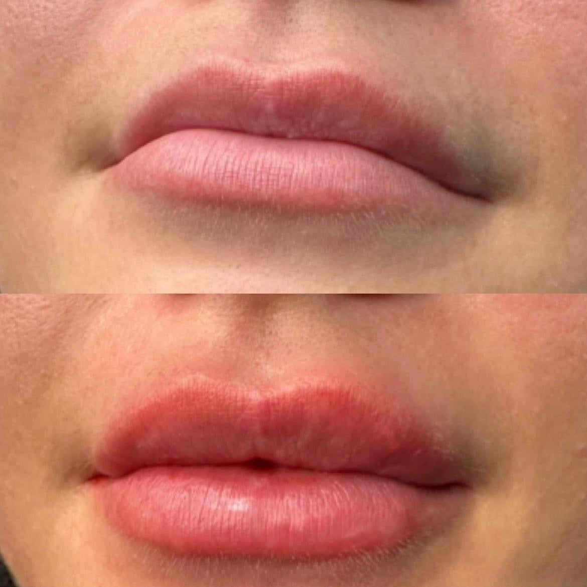 Botox